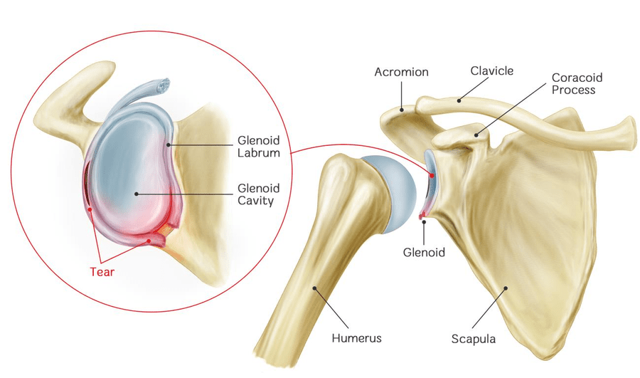 How To Fix A Shoulder Labrum Tear - WITHOUT Surgery! - Brookfield Chiropractor